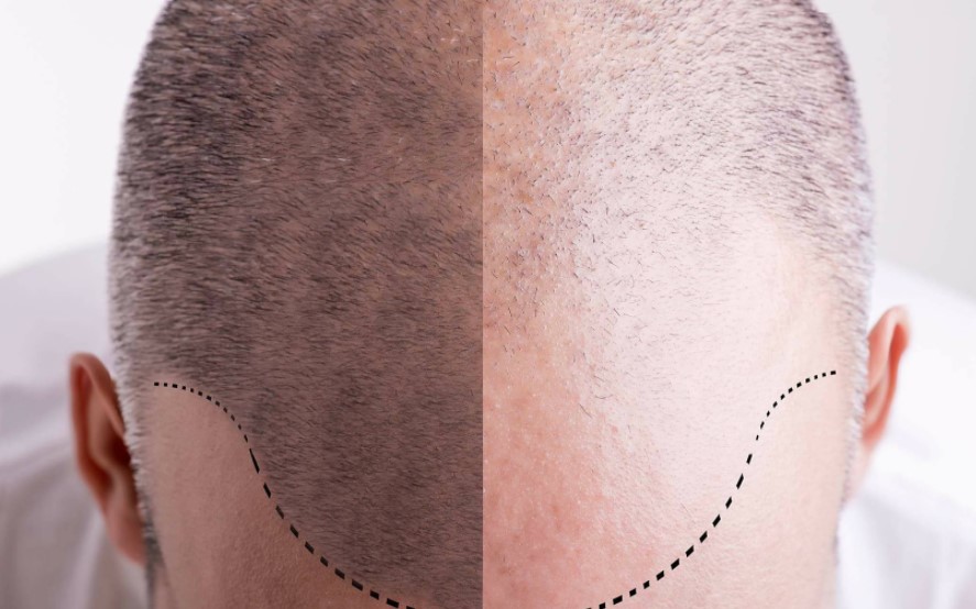 Is a Hair Tattoo the Right Hair Loss Treatment for You?